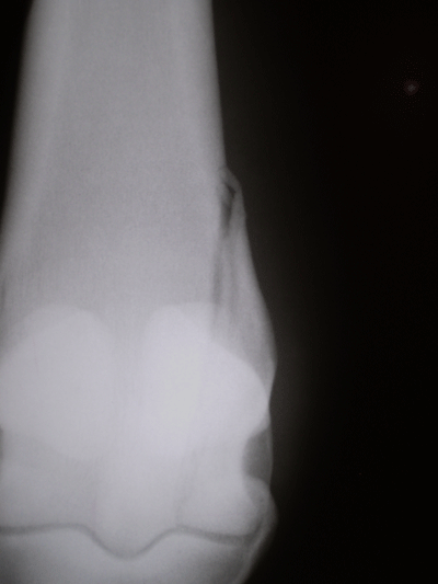 fraturacondilar2.gif